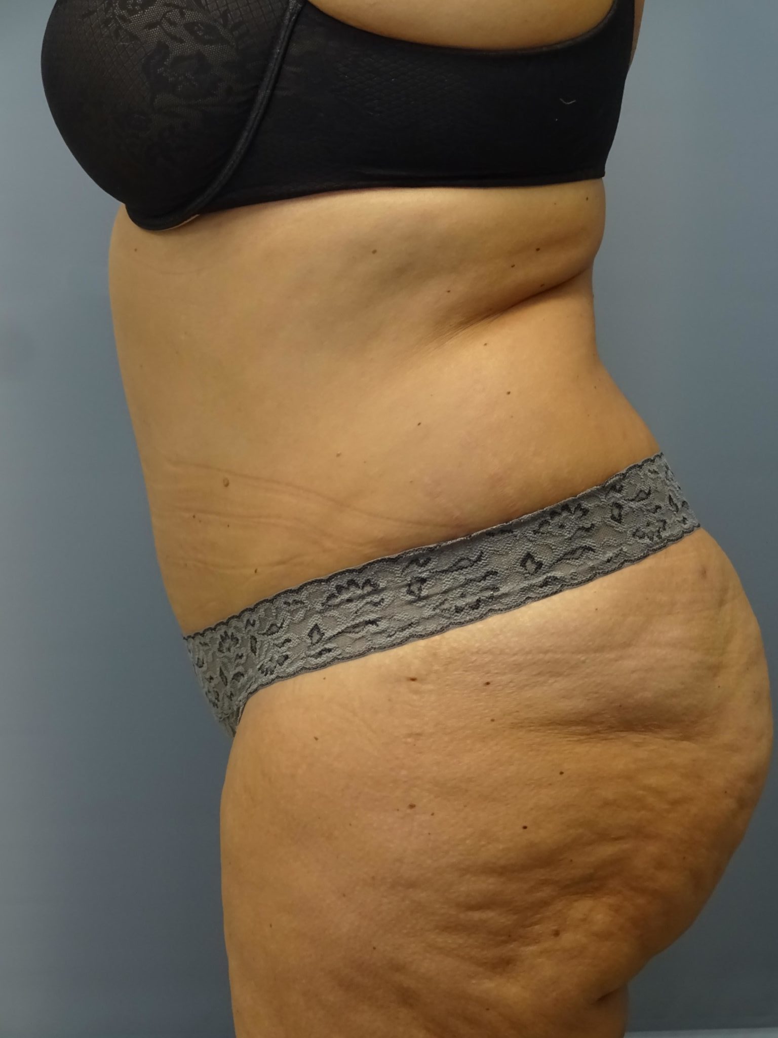 Tummy Tuck Patient Photo - Case 9234 - after view-1