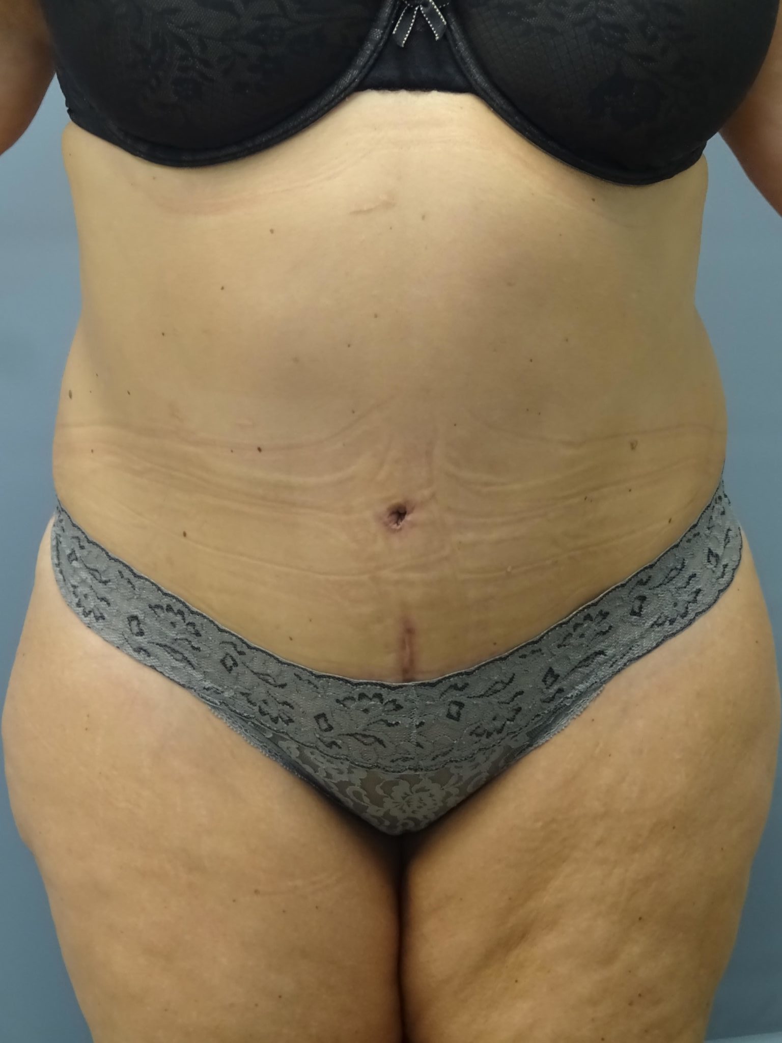 Avelar Tummy Tuck Patient Photo - Case 9234 - after view-0