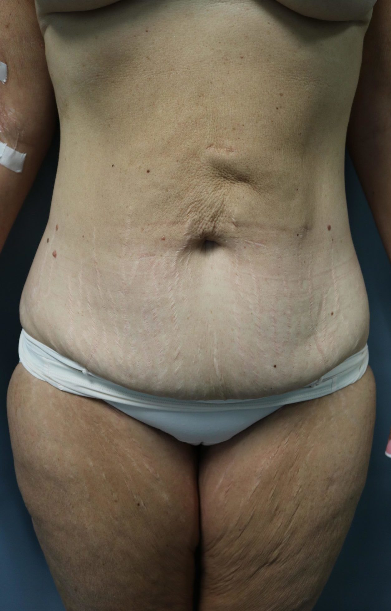 Avelar Tummy Tuck Patient Photo - Case 9244 - before view-0