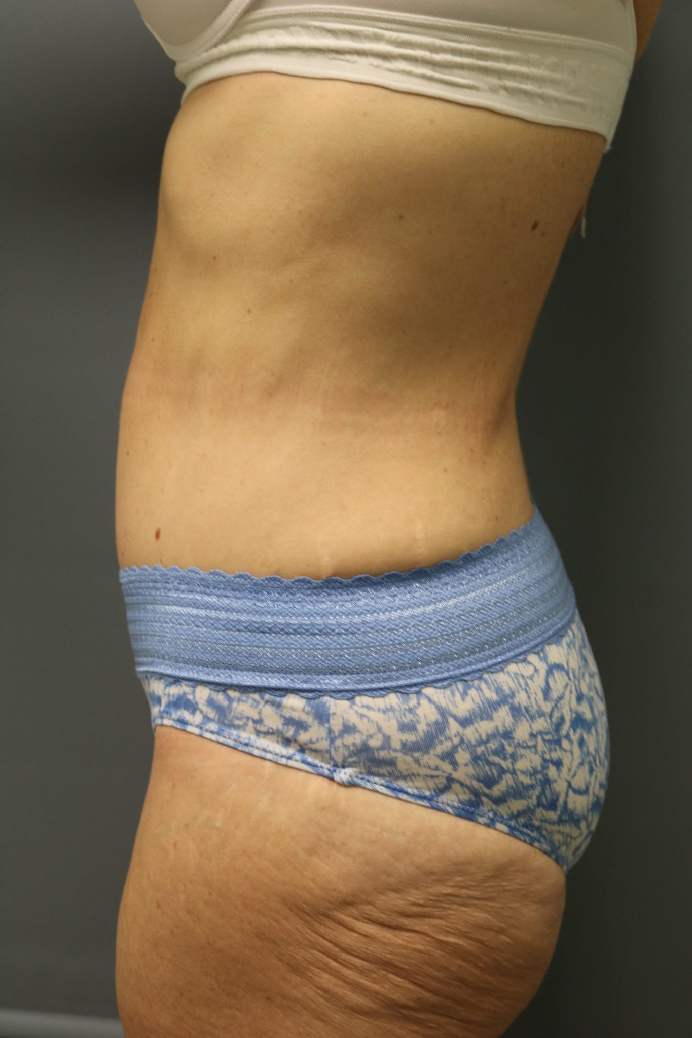 Avelar Tummy Tuck Patient Photo - Case 9244 - after view-1