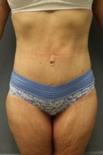 Tummy Tuck - Case 9244 - After