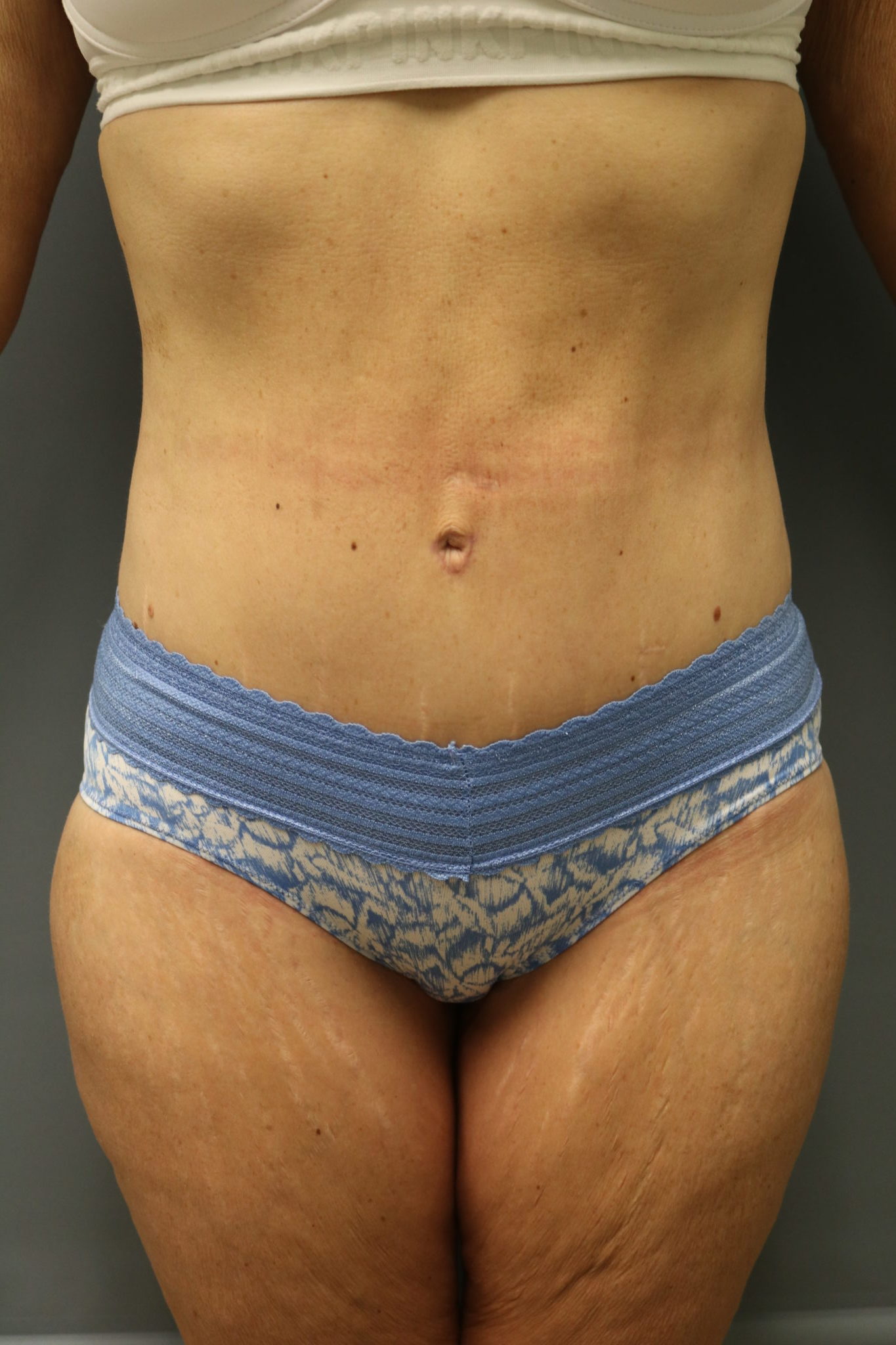 Avelar Tummy Tuck Patient Photo - Case 9244 - after view