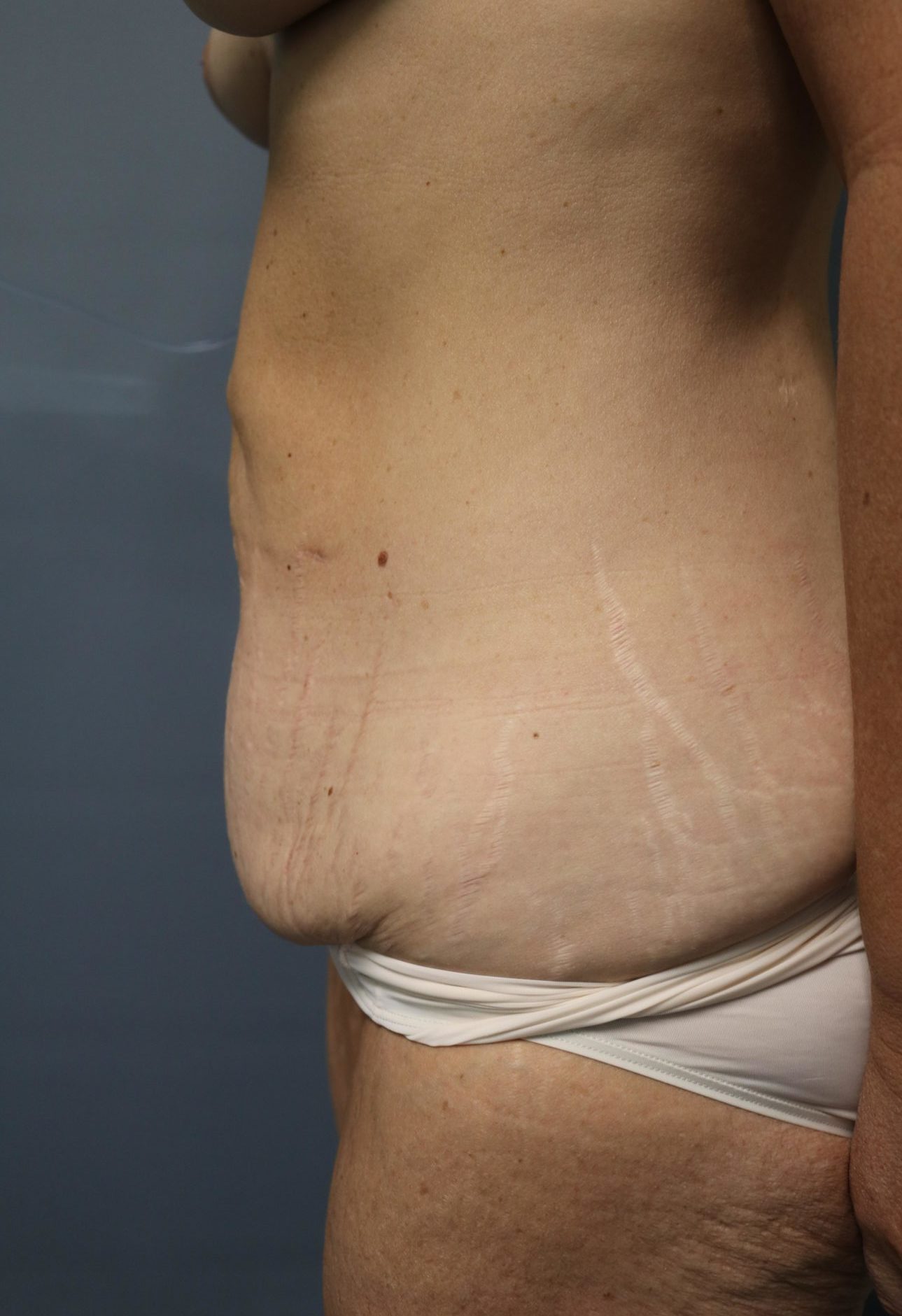 Tummy Tuck Patient Photo - Case 9244 - before view-1