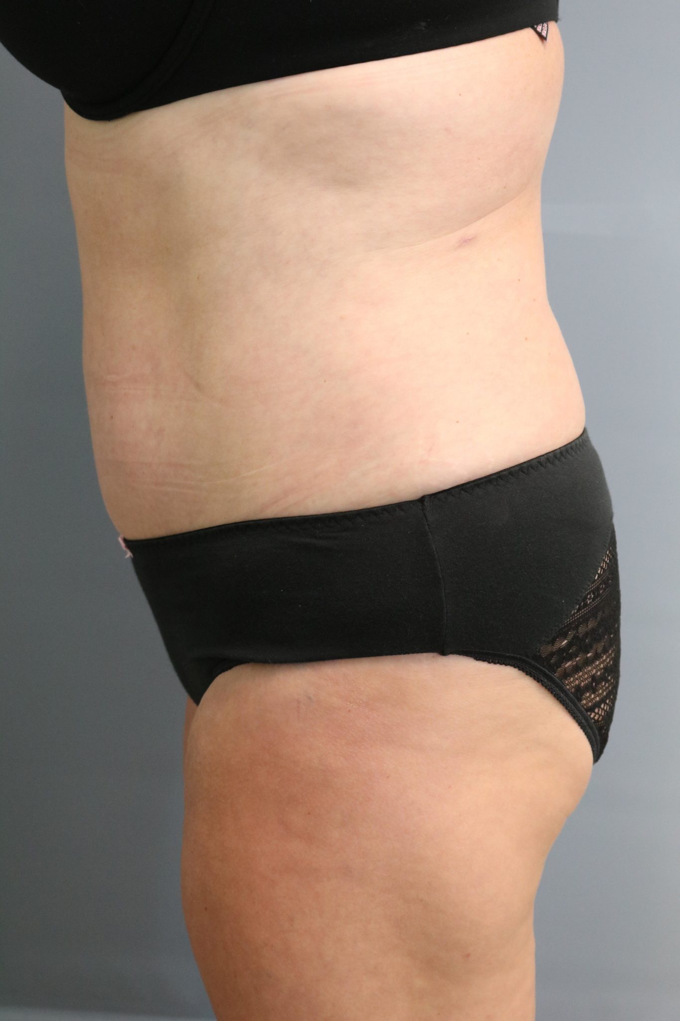 Tummy Tuck Patient Photo - Case 9245 - after view-1