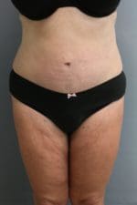 Tummy Tuck - Case 9245 - After