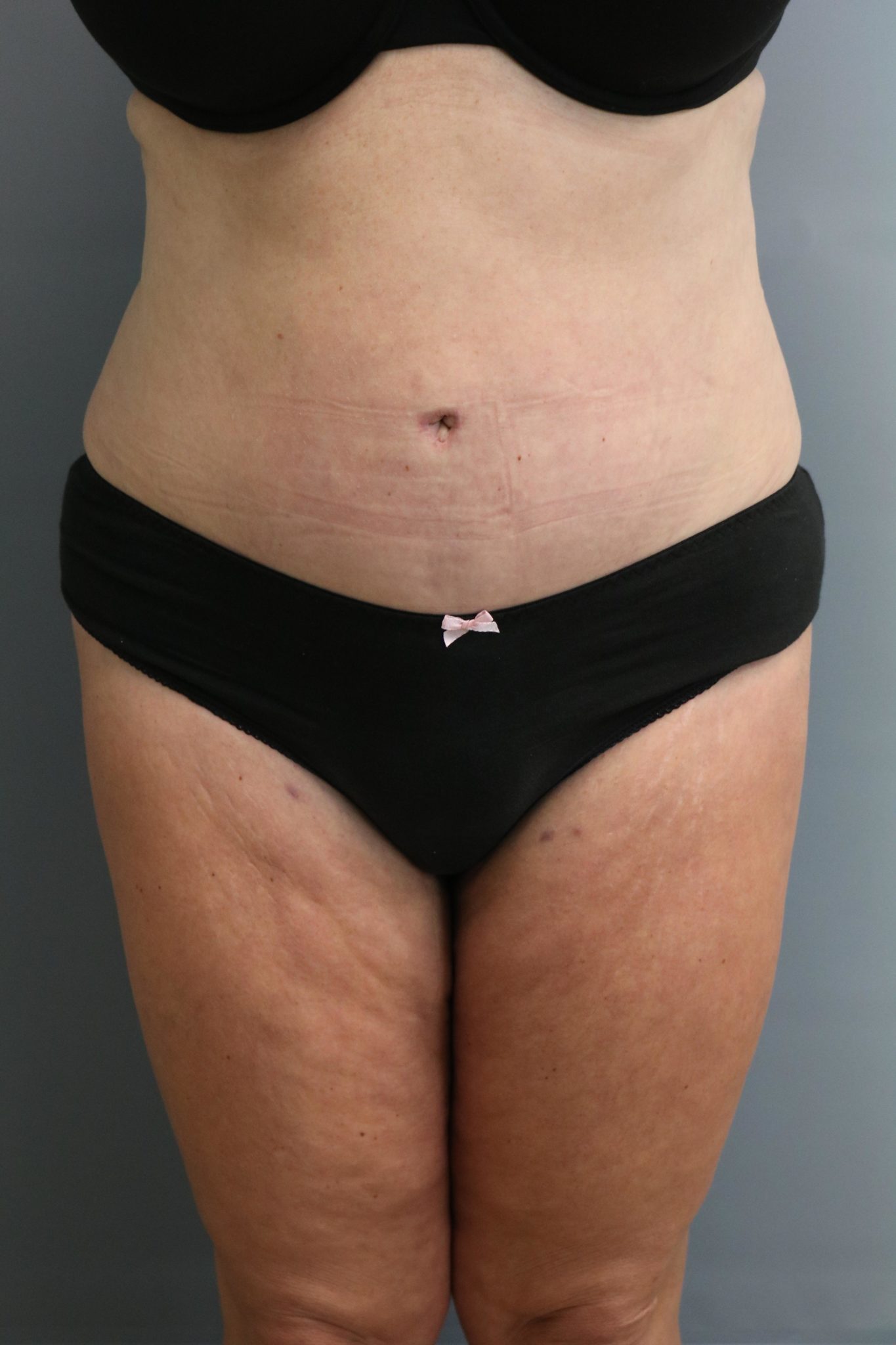 Tummy Tuck Patient Photo - Case 9245 - after view