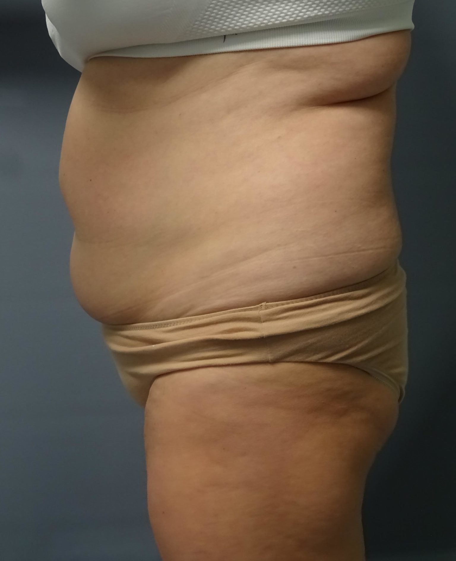 Tummy Tuck Patient Photo - Case 9245 - before view-1