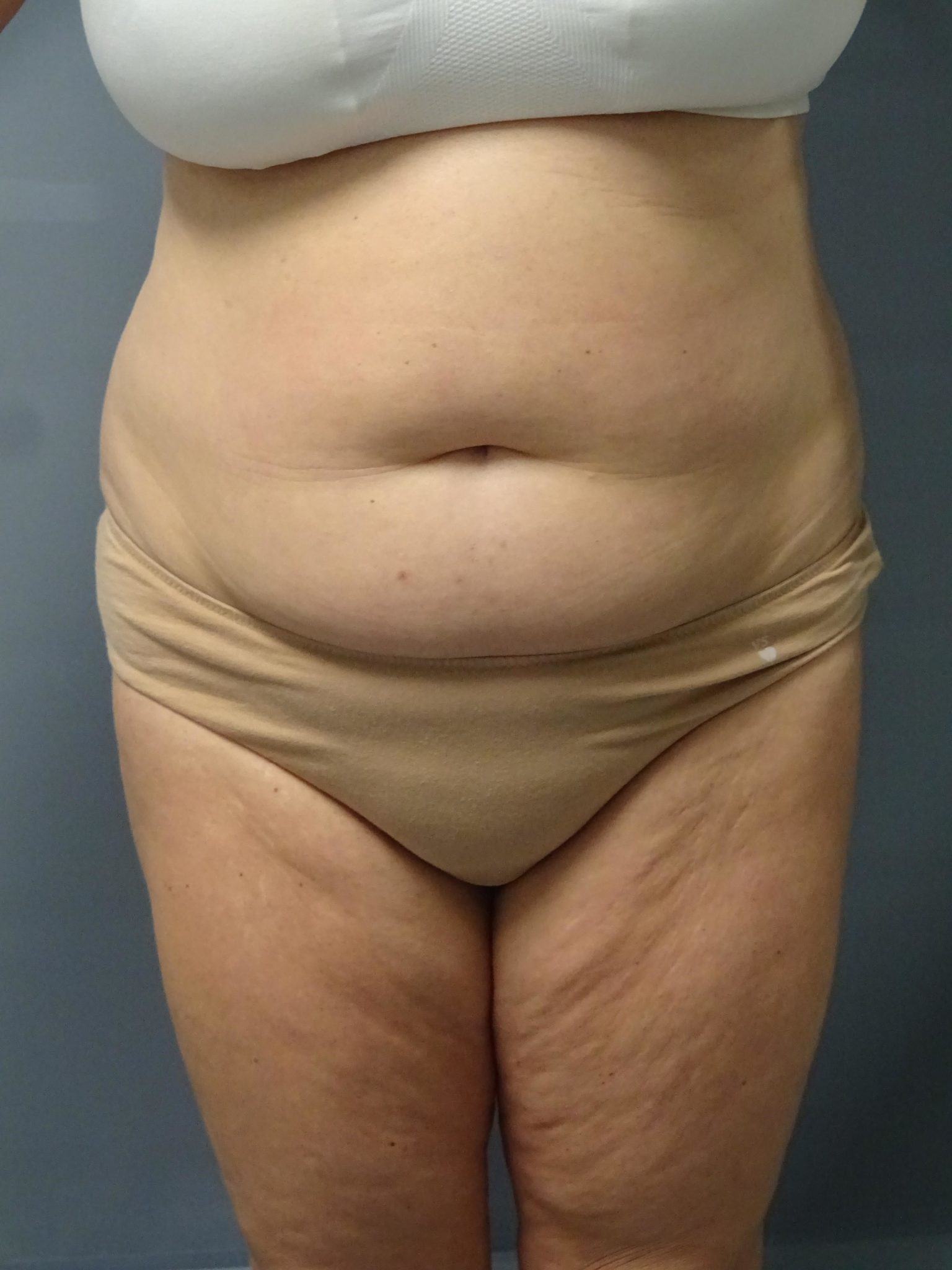 Tummy Tuck Patient Photo - Case 9245 - before view-0