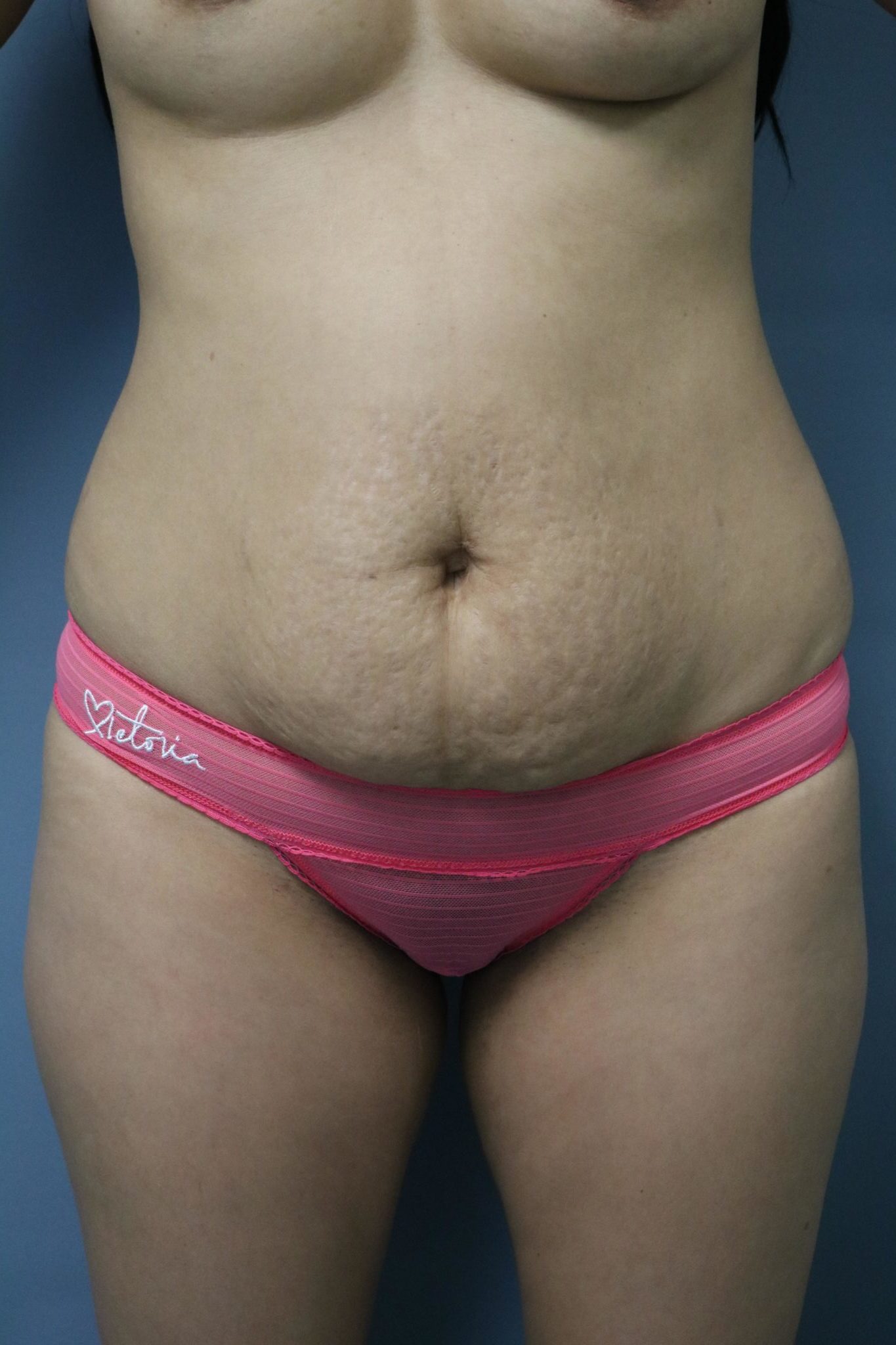 Tummy Tuck Patient Photo - Case 9250 - before view-