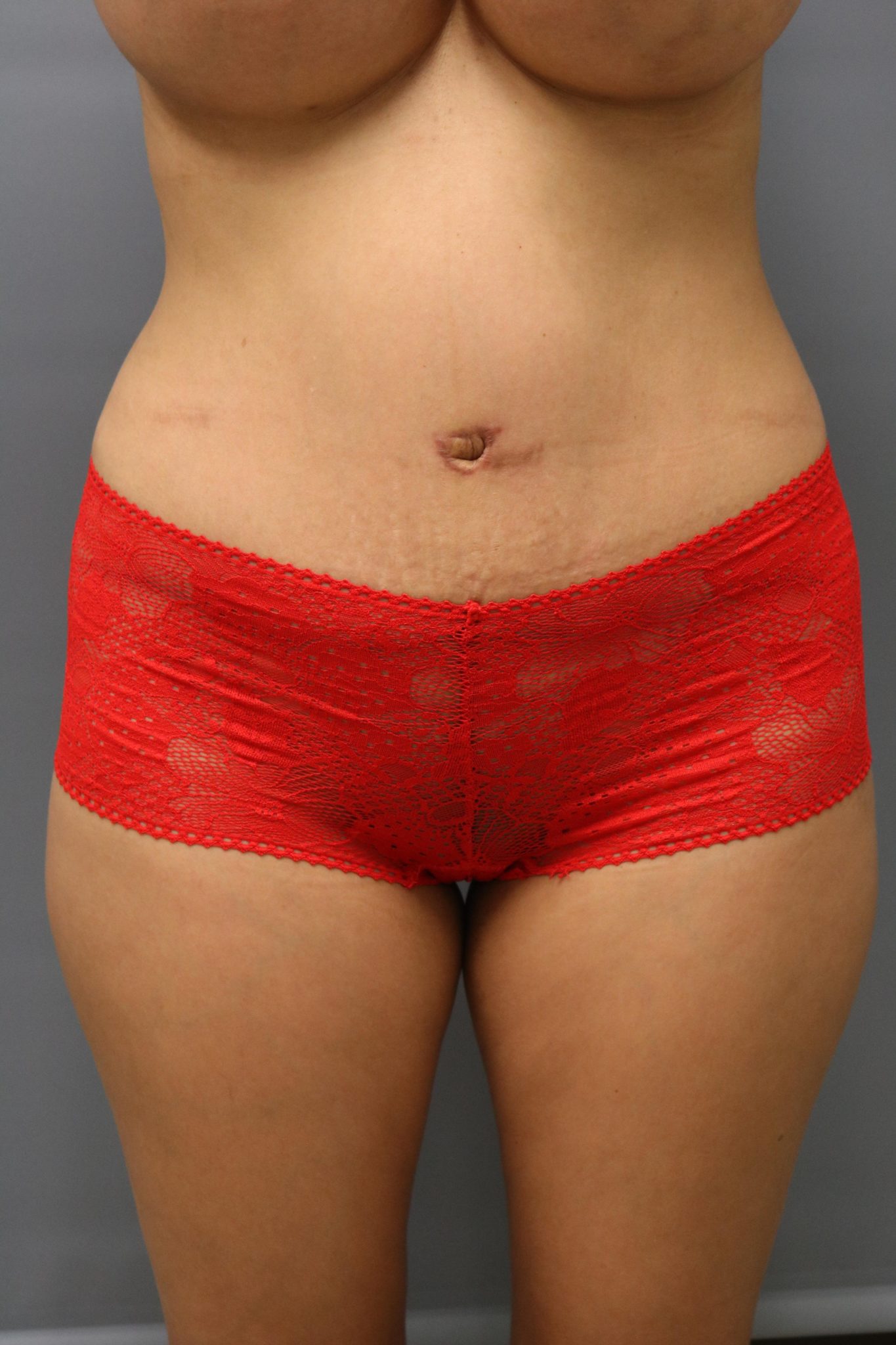 Tummy Tuck Patient Photo - Case 9250 - after view-0