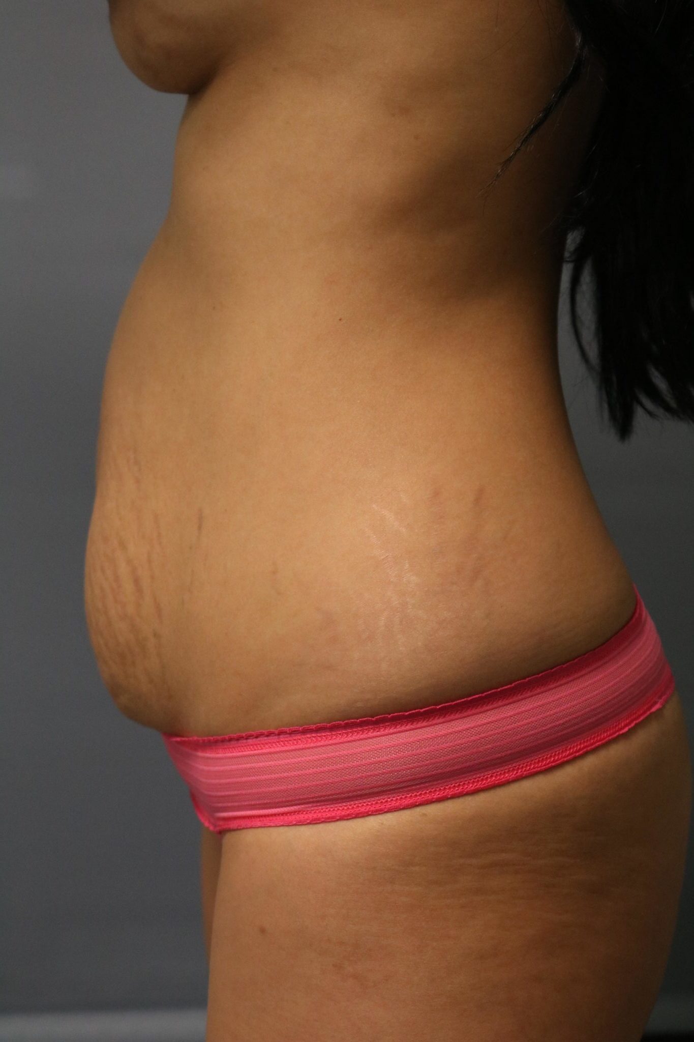 Tummy Tuck Patient Photo - Case 9250 - before view-1
