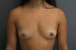 Breast Augmentation - Case 9255 - Before