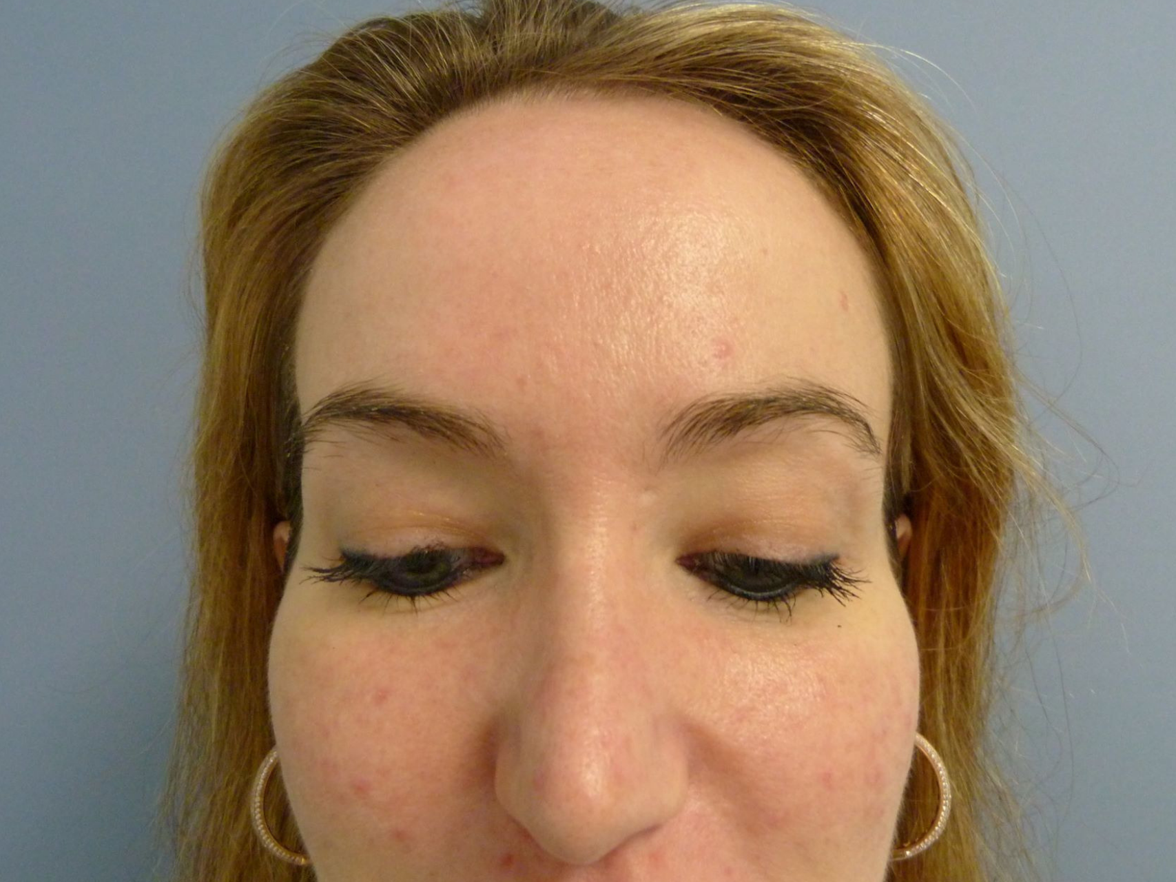 Injectable Fillers Patient Photo - Case 9285 - before view-