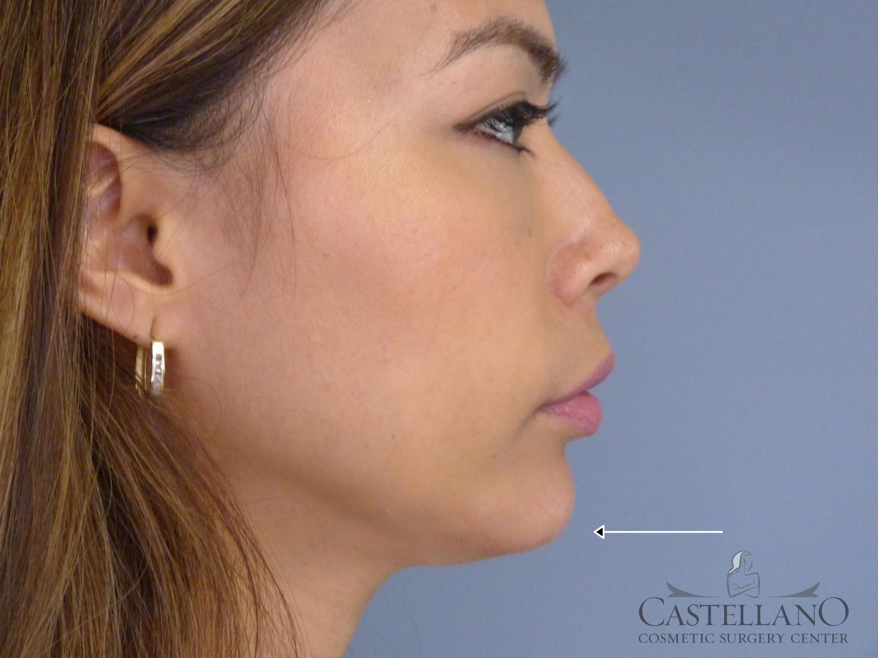 Injectable Fillers Patient Photo - Case 9281 - after view-0