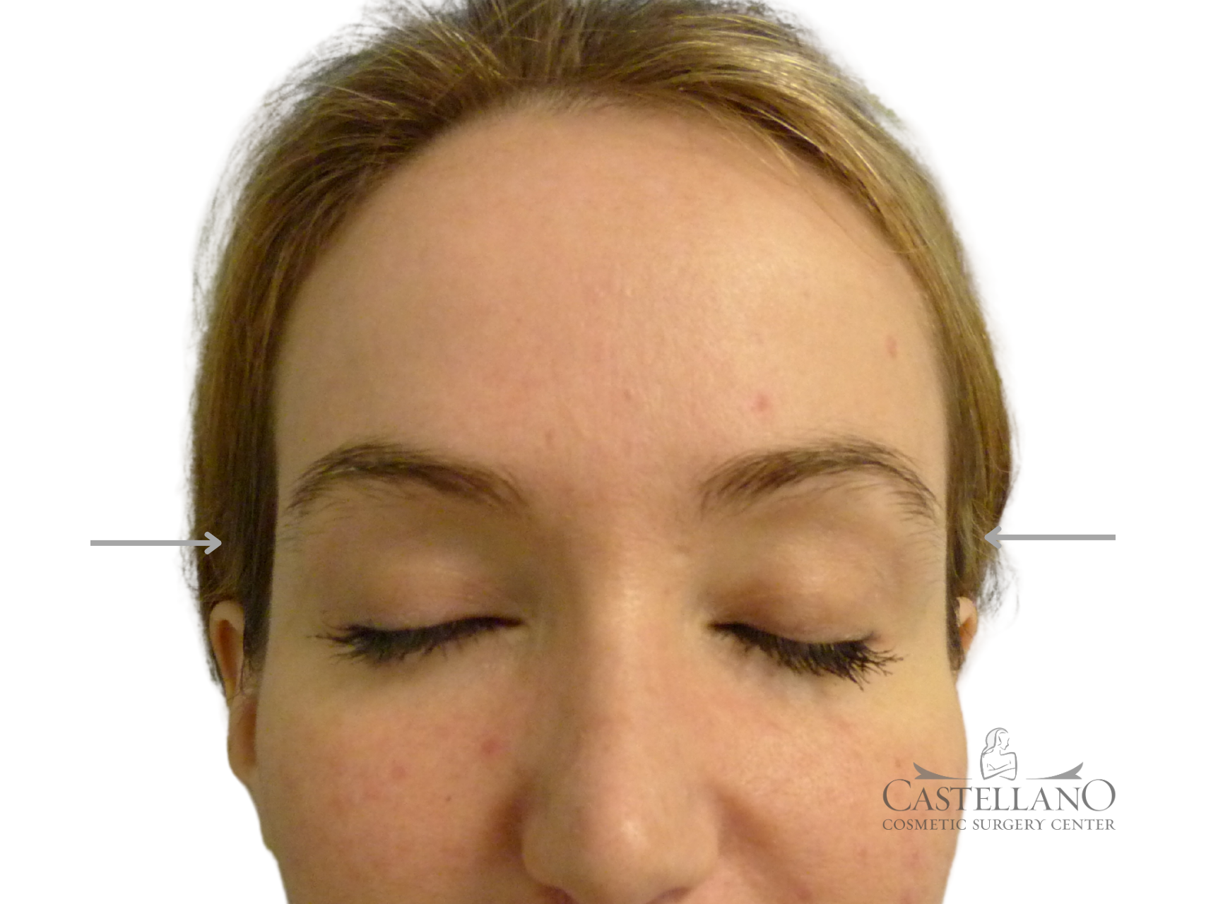 Injectable Fillers Patient Photo - Case 9285 - after view-0