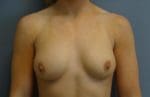 Breast Augmentation - Case 10178 - Before