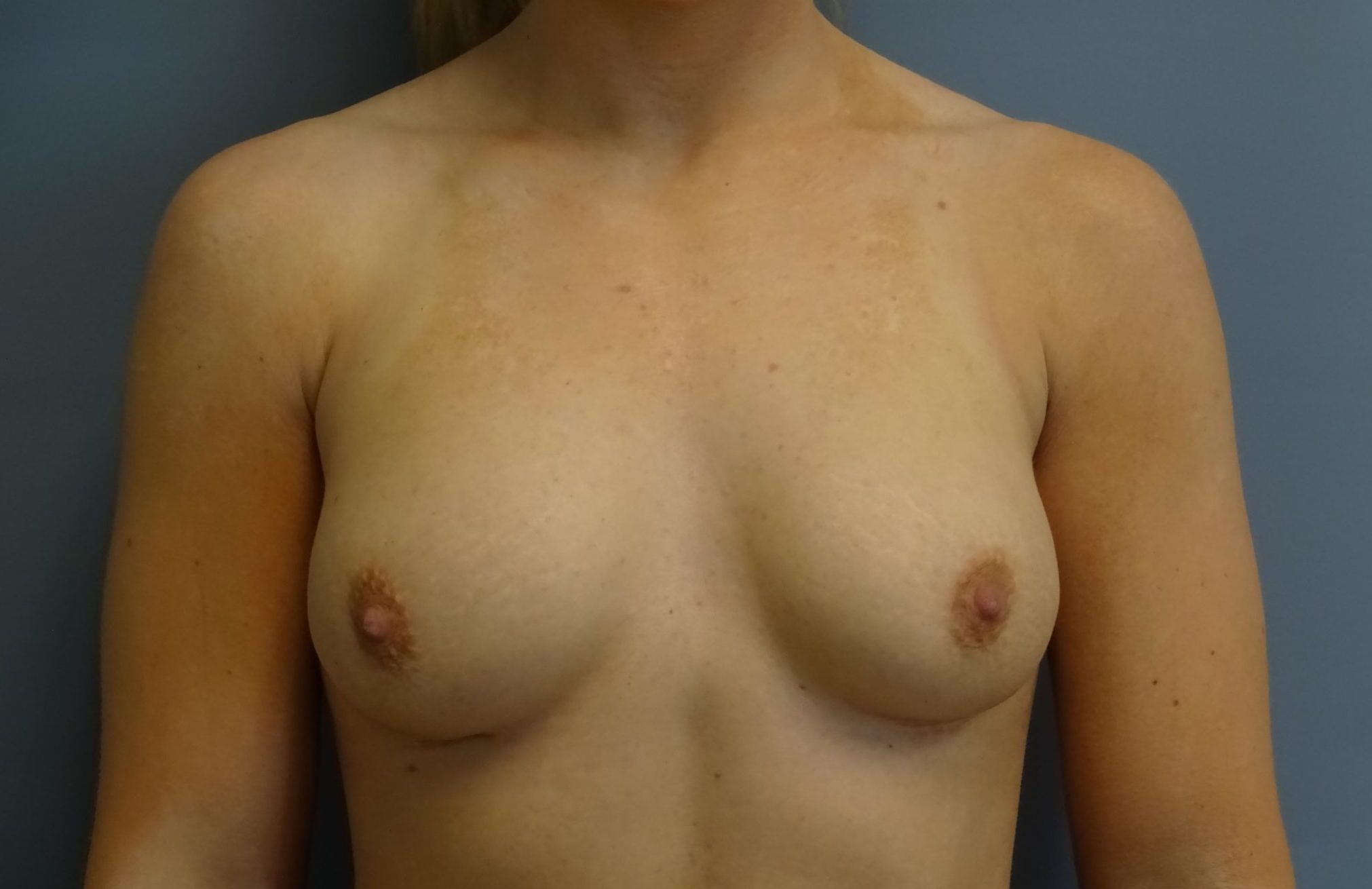 Breast Augmentation Patient Photo - Case 10178 - before view-0