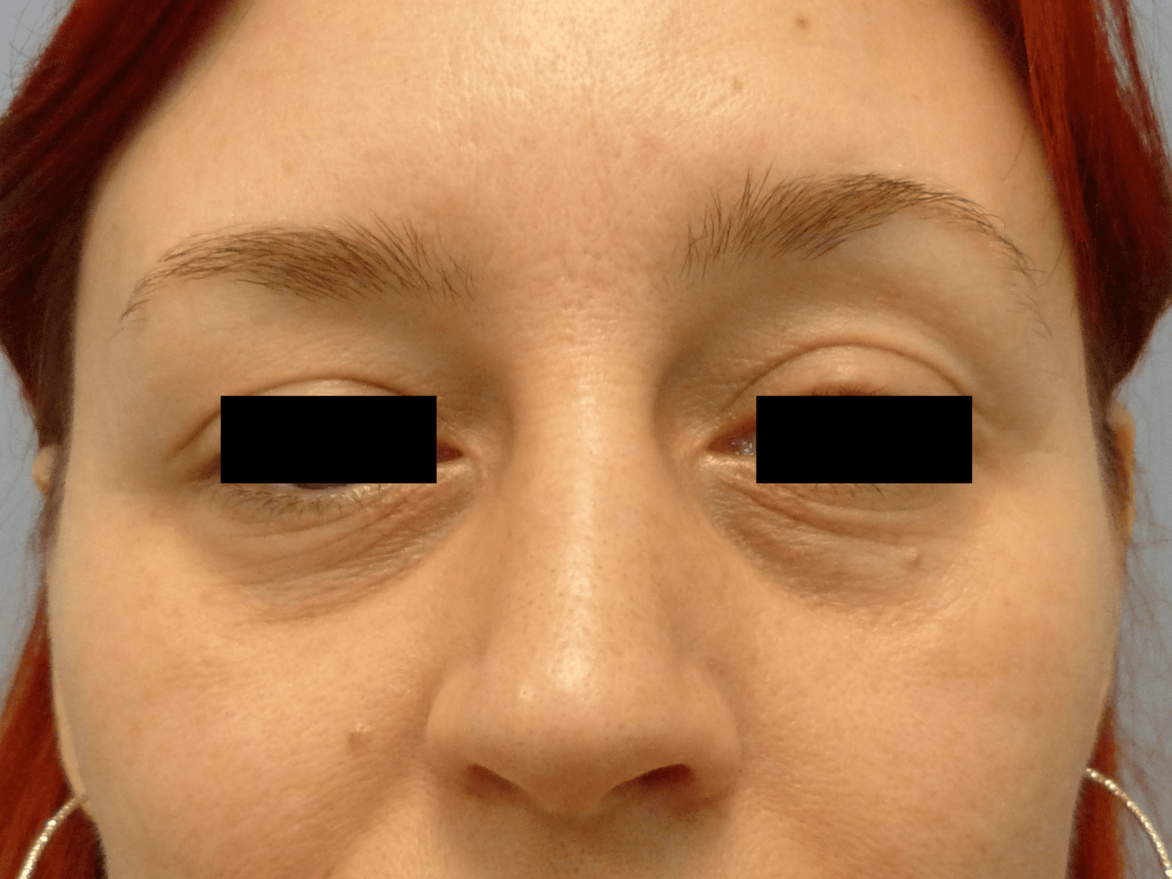 Injectable Fillers Patient Photo - Case 16201 - before view-