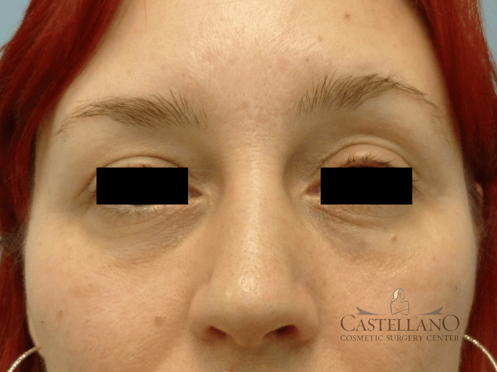Injectable Fillers Patient Photo - Case 16201 - after view