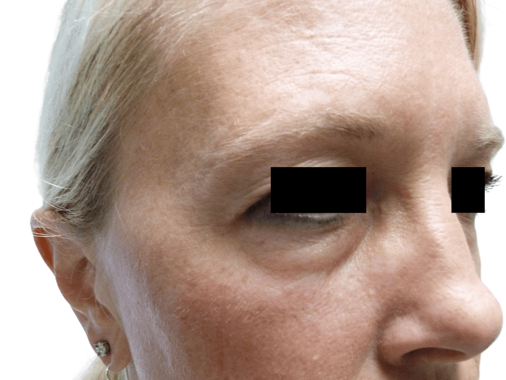 Injectable Fillers Patient Photo - Case 16211 - before view-0