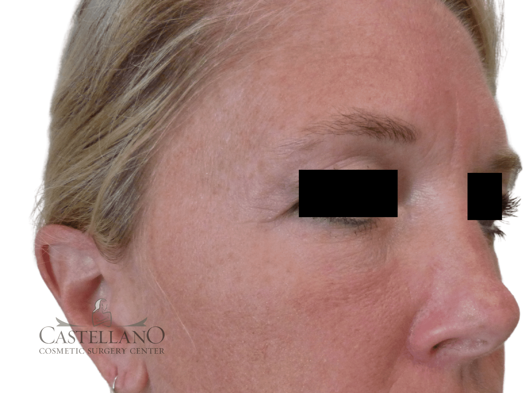 Injectable Fillers Patient Photo - Case 16211 - after view-0