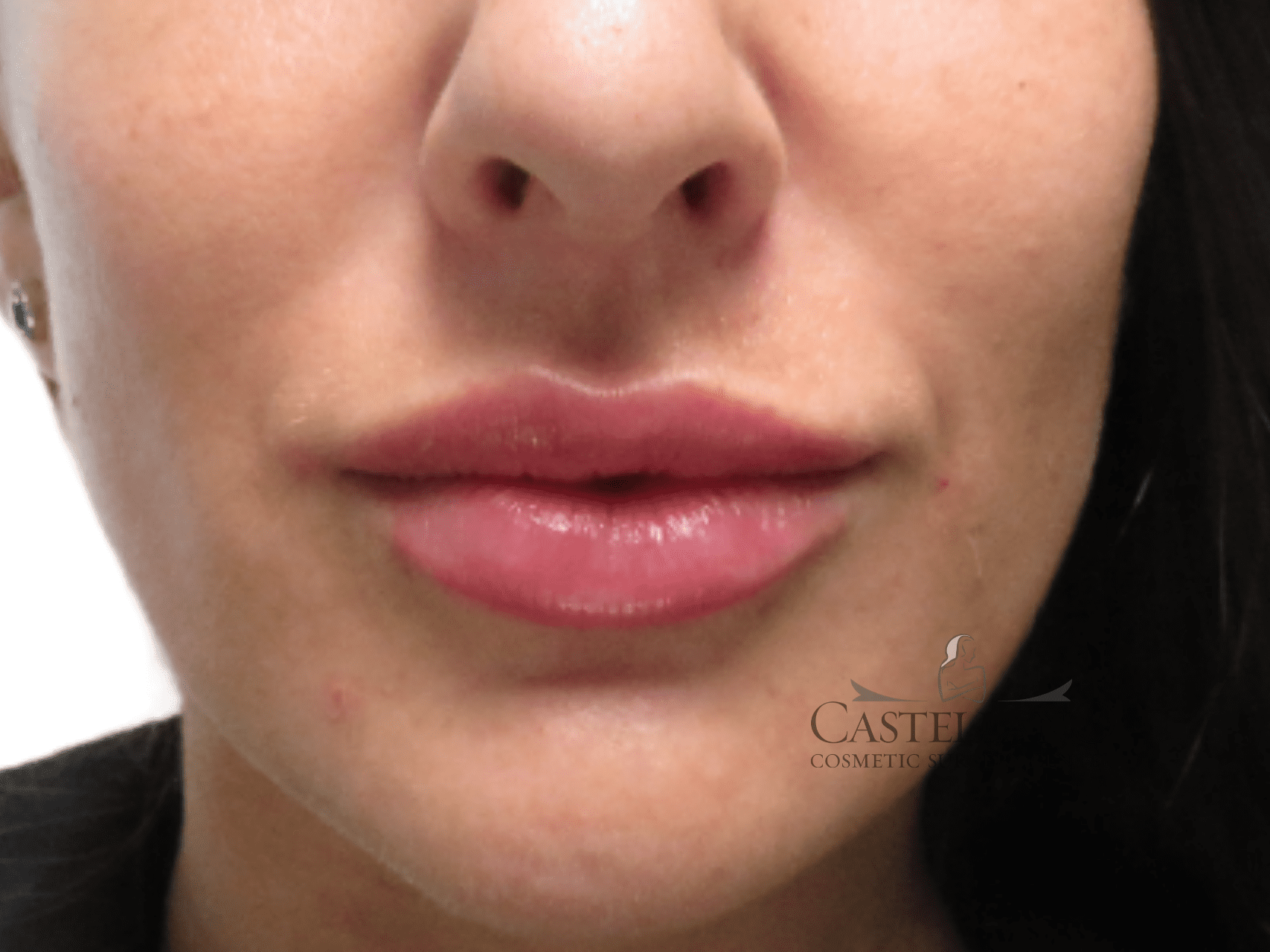 Injectable Fillers Patient Photo - Case 16329 - after view