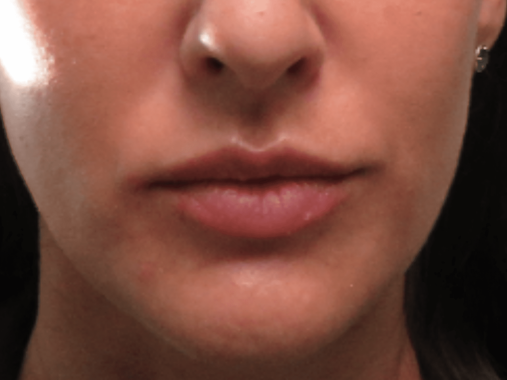 Injectable Fillers Patient Photo - Case 16329 - before view-