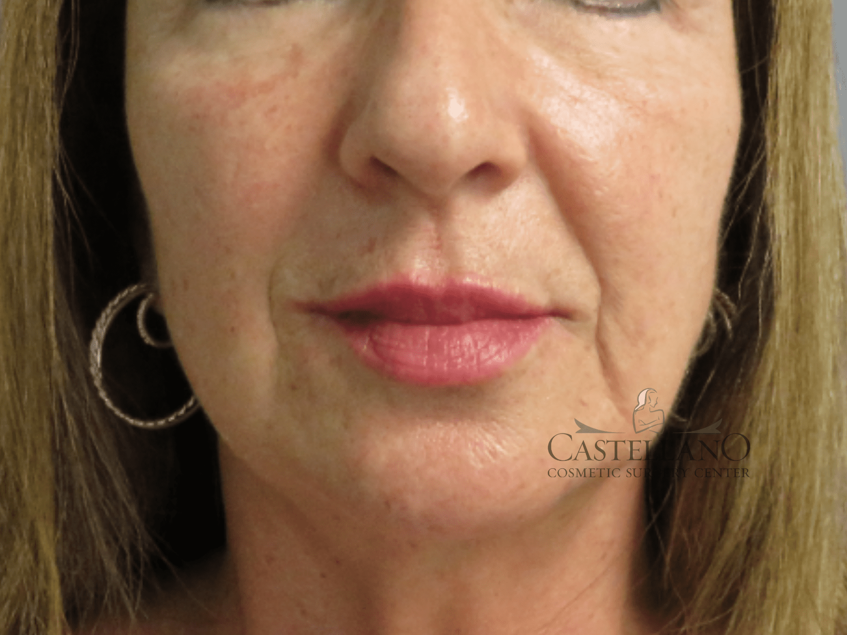 Injectable Fillers Patient Photo - Case 16321 - after view