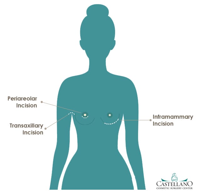 Breast-Implant-Incisions-Dr.-Castellano 13 expert answers to Your Breast Augmentation Questions