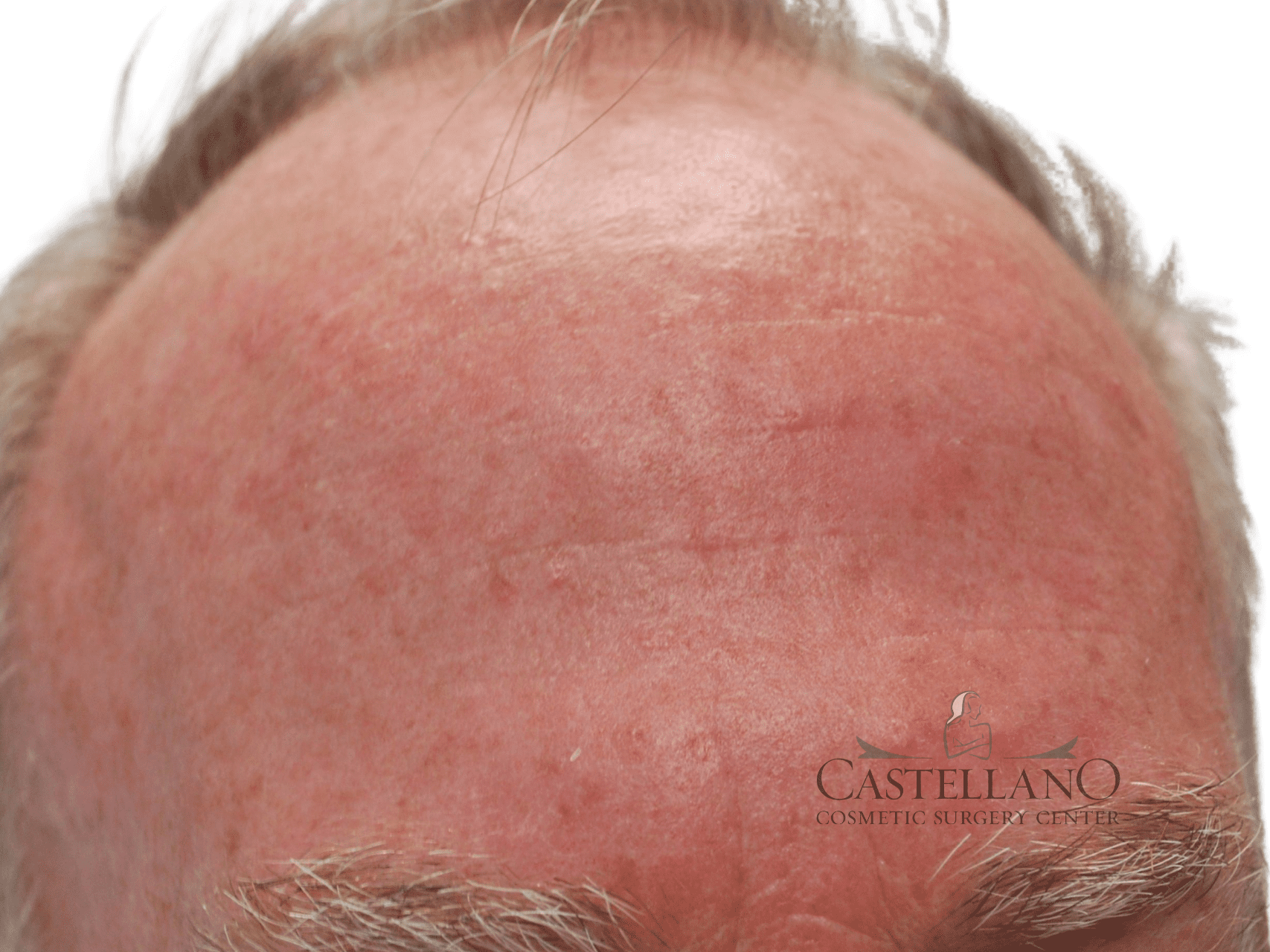 Laser Treatments Patient Photo - Case 16747 - after view