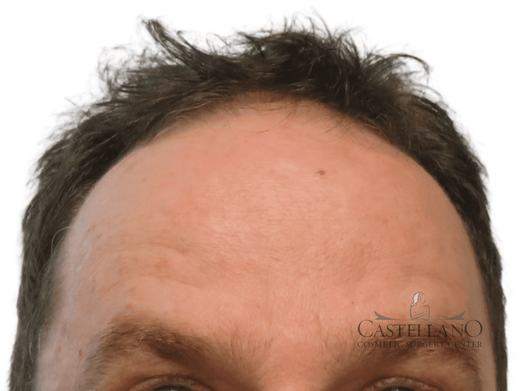 BOTOX® Cosmetic Patient Photo - Case 16743 - after view-0