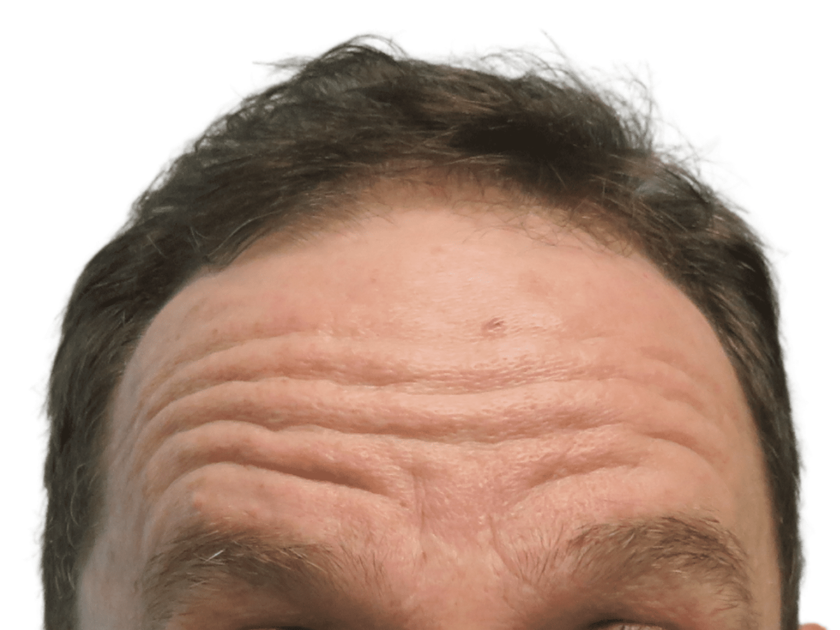 BOTOX® Cosmetic Patient Photo - Case 16743 - before view-0