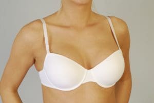 Breast Reduction - Castellano