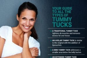 Castellano - Tummy Tuck - Infographic - Nov 2021