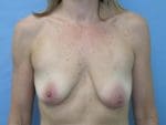 Breast Augmentation - Case 136 - Before