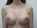 Breast Augmentation - Case 155 - After