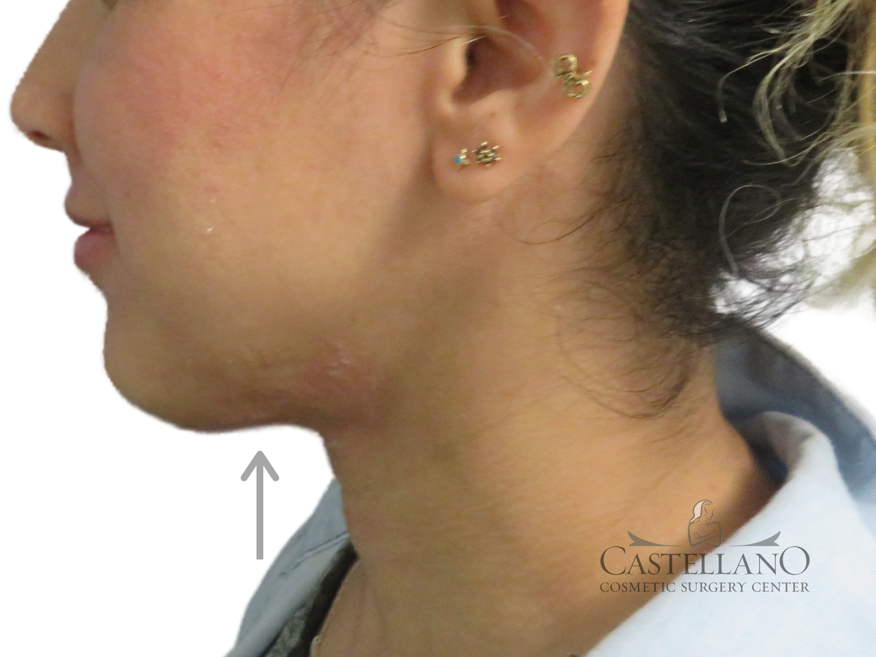 Injectable Fillers Patient Photo - Case 18166 - after view-0