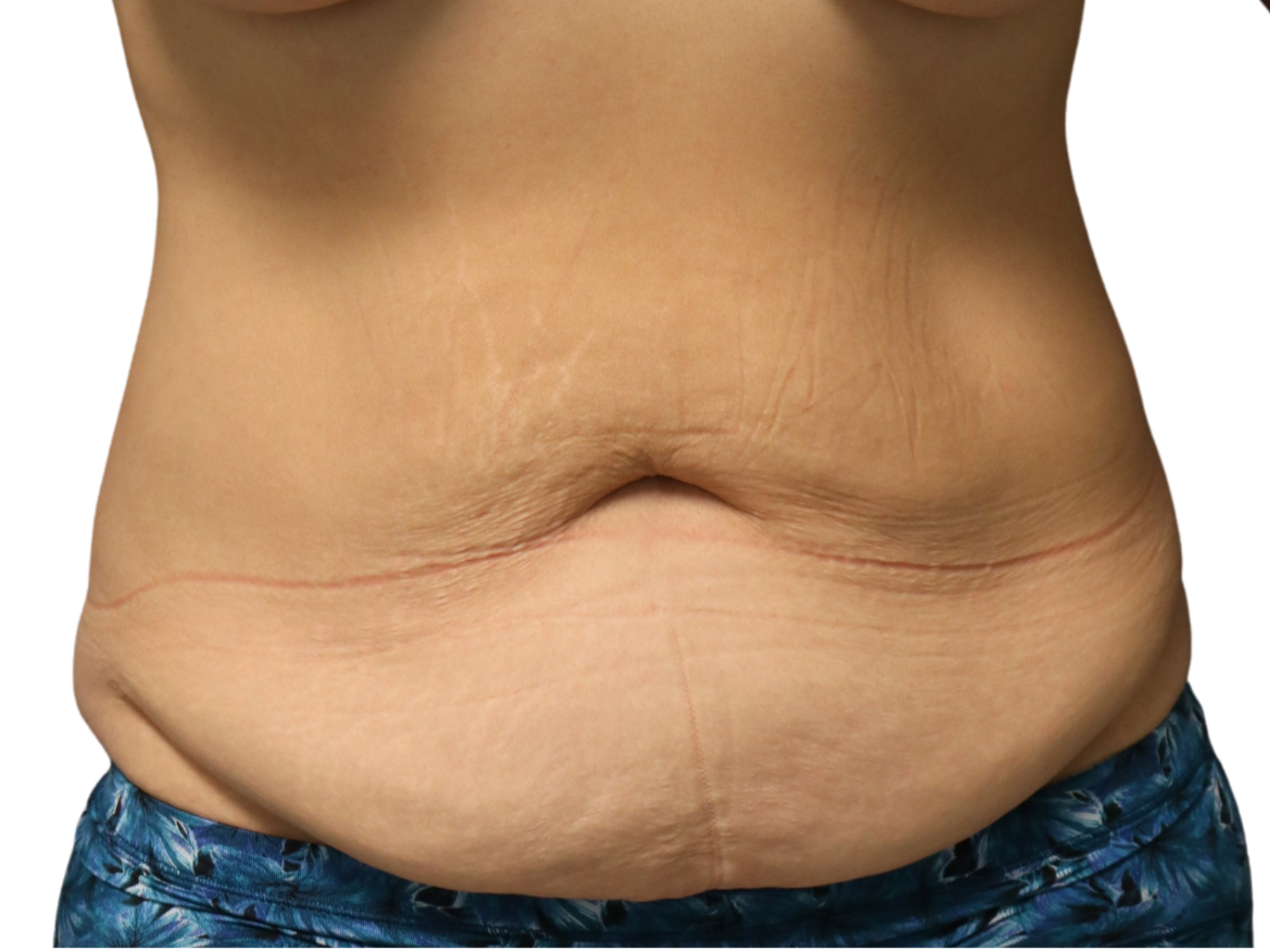 Tummy Tuck Patient Photo - Case 18180 - before view-0