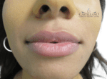 Lip Augmentation - Case 18184 - After
