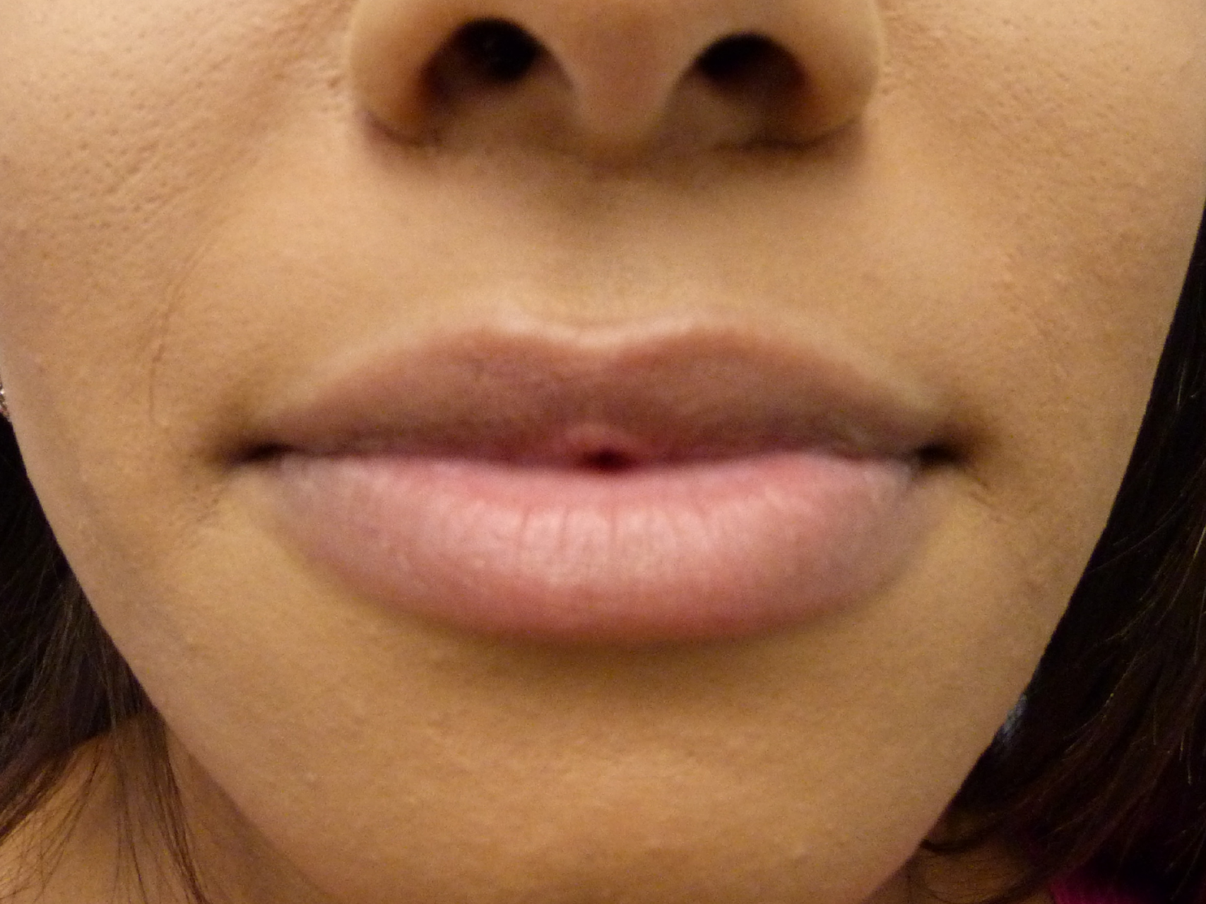 Lip Augmentation Patient Photo - Case 18184 - before view-