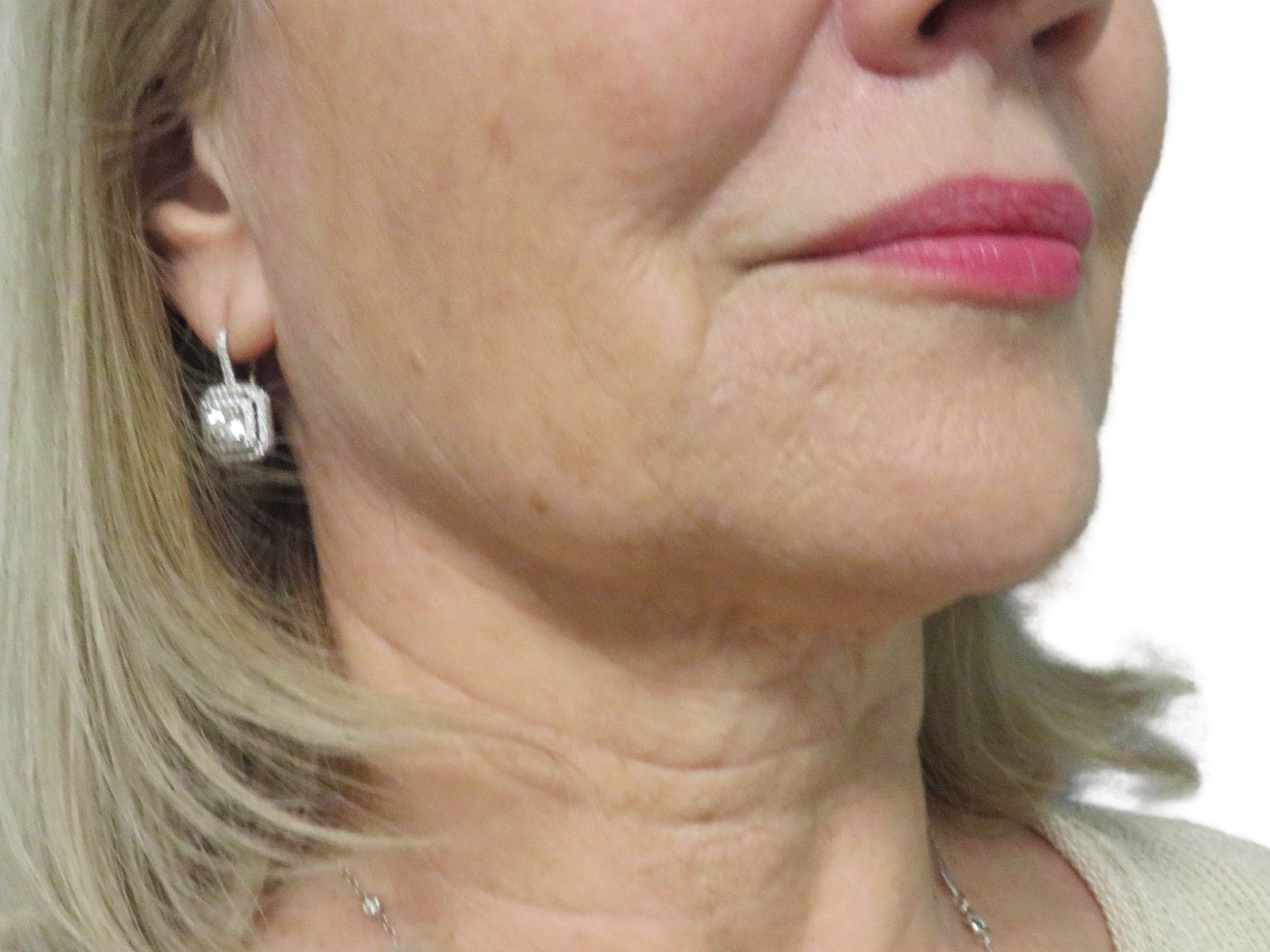 BOTOX® Cosmetic Patient Photo - Case 18195 - before view-0