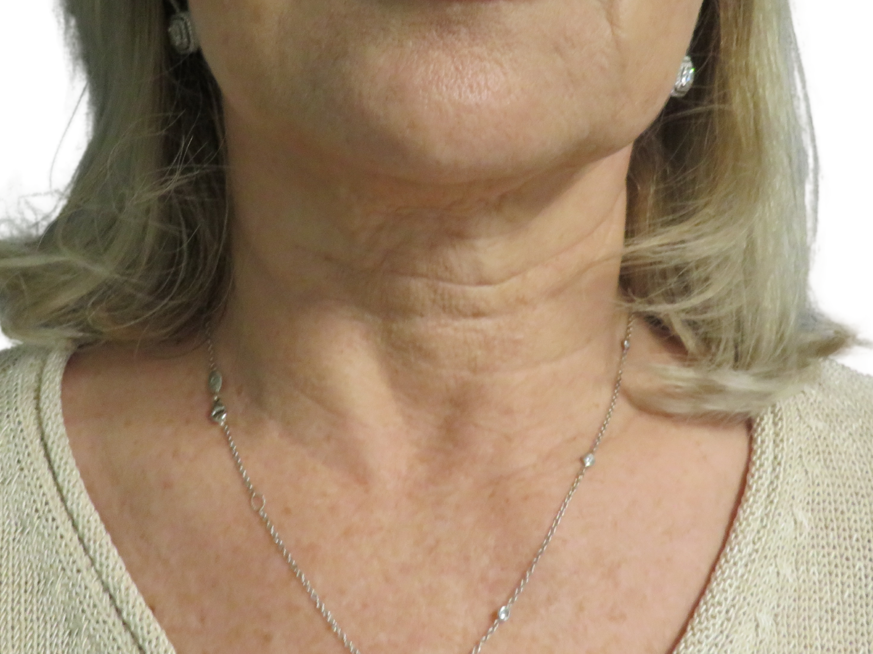 BOTOX® Cosmetic Patient Photo - Case 18195 - before view-1