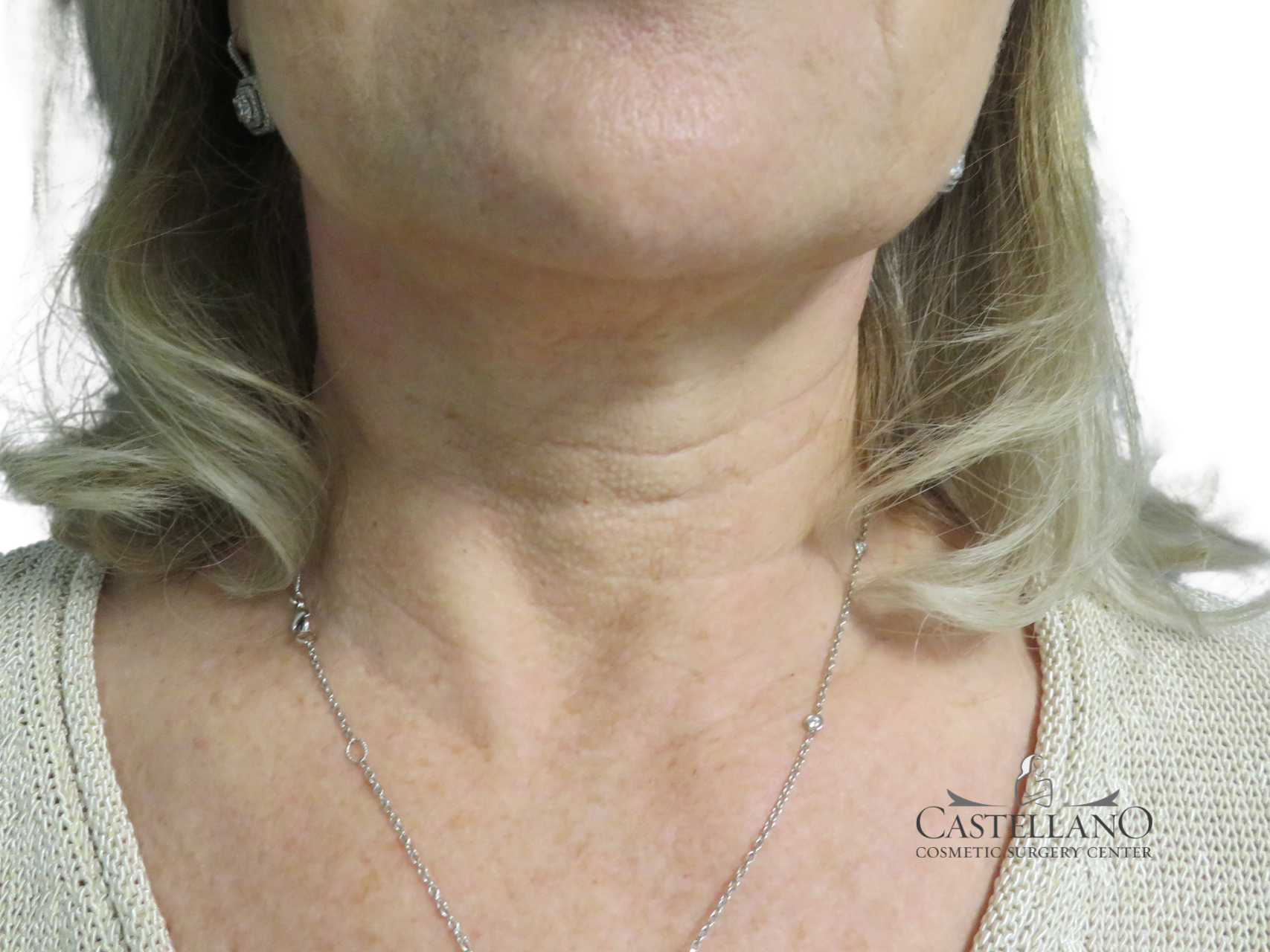 BOTOX® Cosmetic Patient Photo - Case 18195 - after view-1