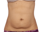 Coolsculpting® - Case 18251 - Before
