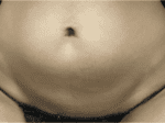 Coolsculpting® - Case 18365 - Before