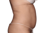 Coolsculpting® - Case 18369 - Before