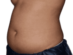 Coolsculpting® - Case 18527 - Before