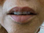 Lip Augmentation - Case 18563 - Before