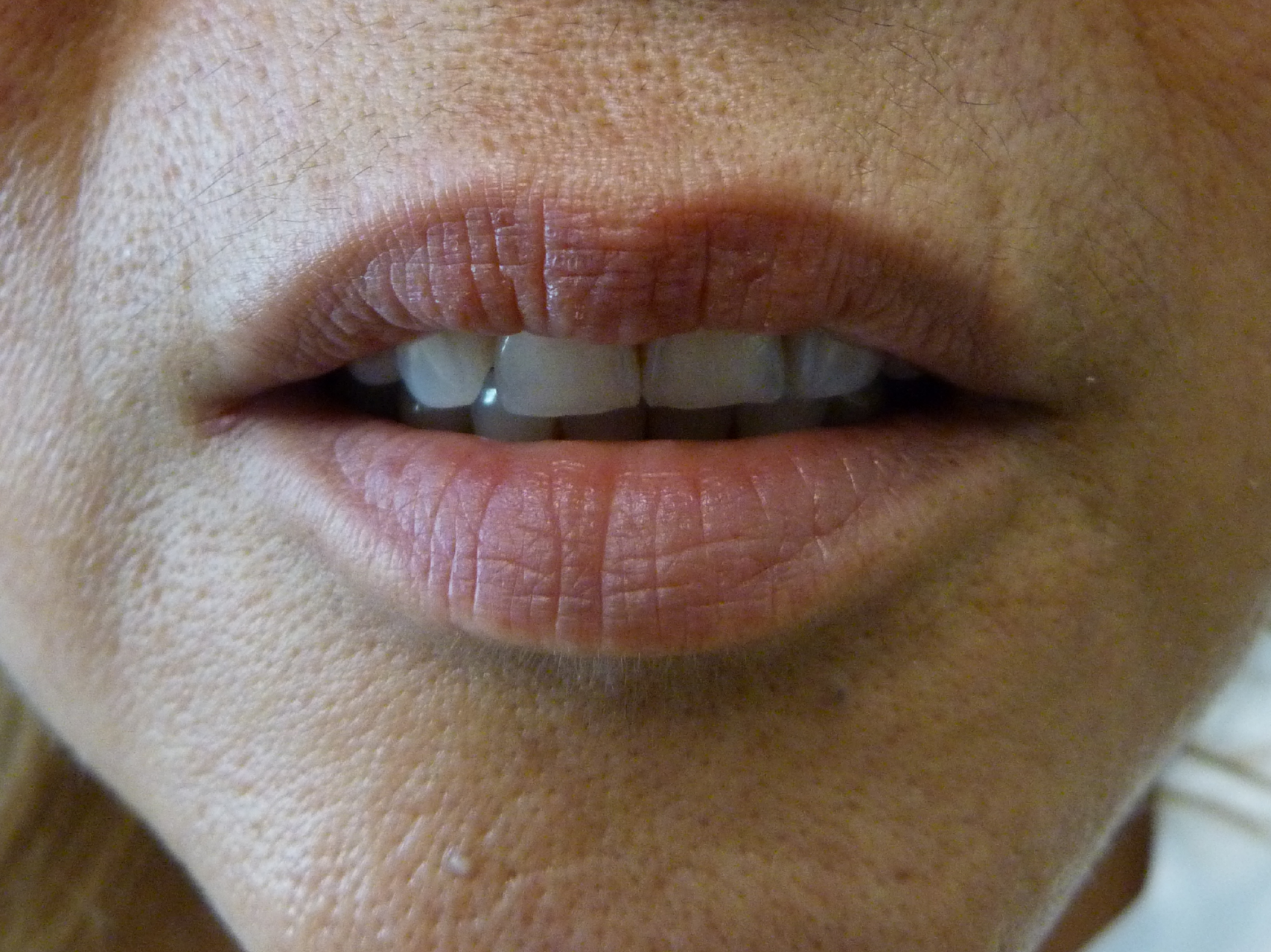 Lip Augmentation Patient Photo - Case 18563 - before view-