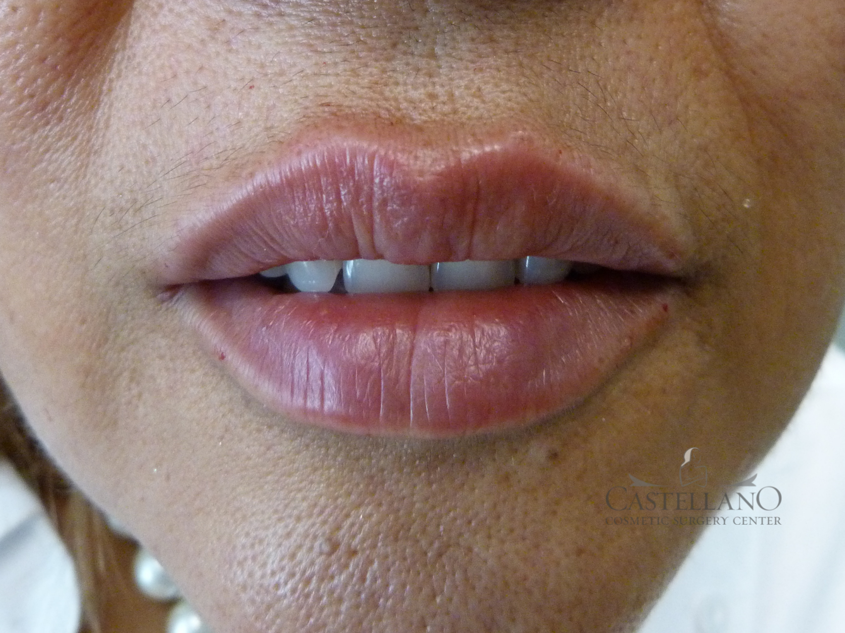 Lip Augmentation Patient Photo - Case 18563 - after view